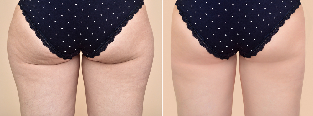 fluid drainage and smoothing out any lumpy fat cells 