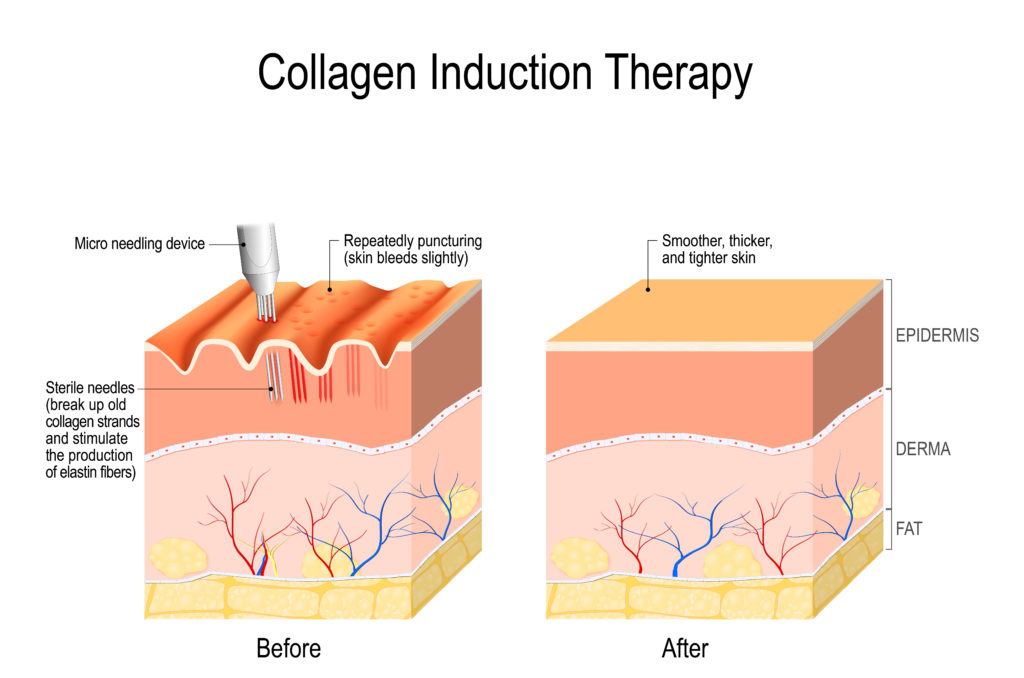 Collagen induction therapy (microneedling) is a surgical for remove wrinkles, scars, stretch, marks, pigmentation. skin needling procedure, repeatedly puncturing the skin with tiny