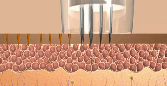 Microneedling for Stretchmarks